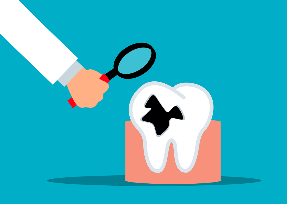 Stages of Tooth Decay and Treatments